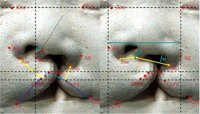 Short-term surgical outcomes in patients with unilateral complete cleft lip and palate after presurgical nasoalveolar molding therapy: A three-dimensional anthropometric study